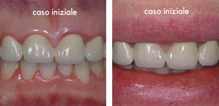 Corone dentali