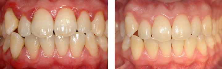 Diagnosi parodontite