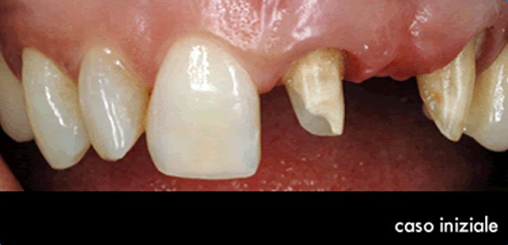 Ponte a più elementi dentali