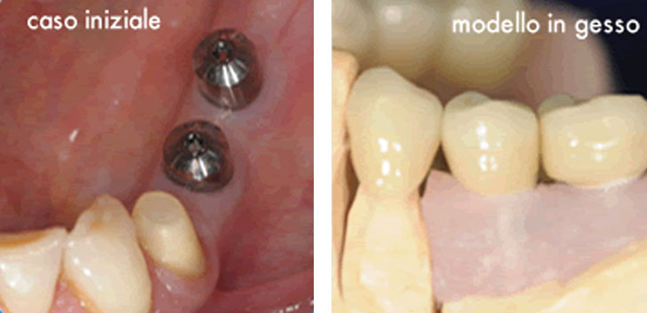 Riabilitazione di più elementi dentali