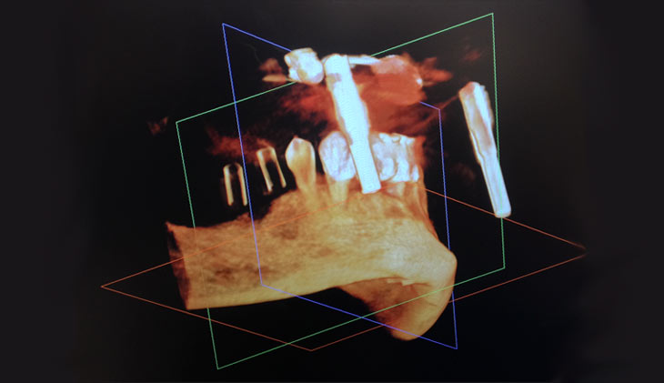 Implantologia 3D guidata