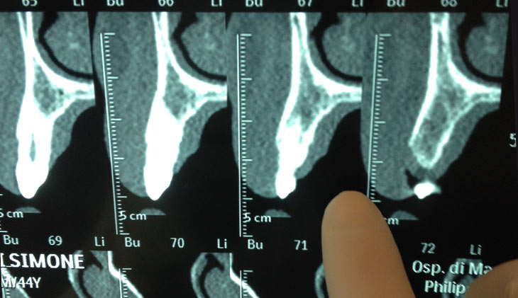 Implantologia 3D guidata