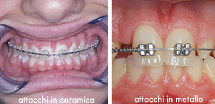 Apparecchio ortodontico dentale con dentiera Allineamento denti,  apparecchio dentale, apparecchio ortodontico, trainer, apparecchio dentale,  allineatore