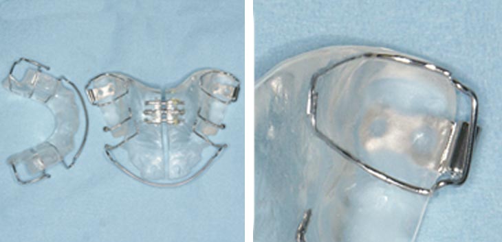 Apparecchi Ortodontici mobili
