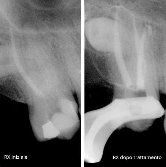 granuloma caso clinico
