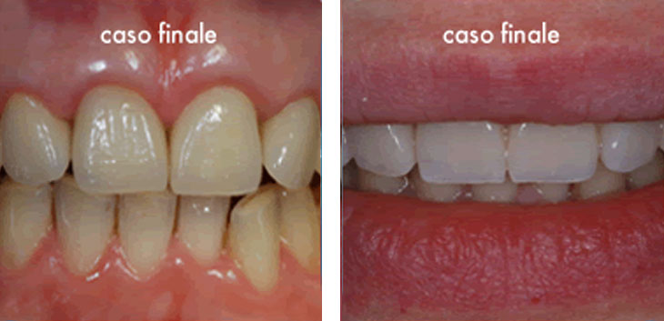 Corone protesi dentarie