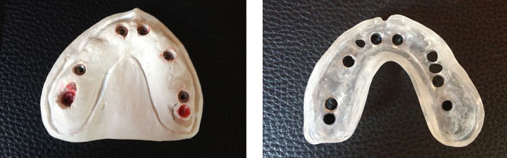 Implantologia 3D guidata