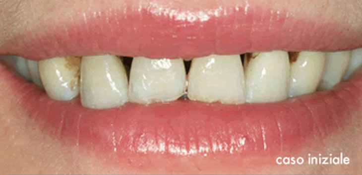Faccette dentali