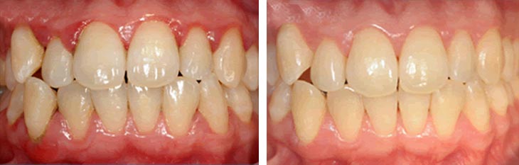 Terpia parodontale per gengivite