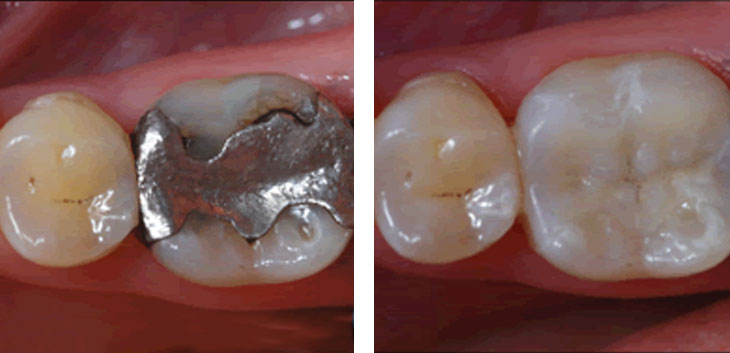 Intarsi dentali in composito