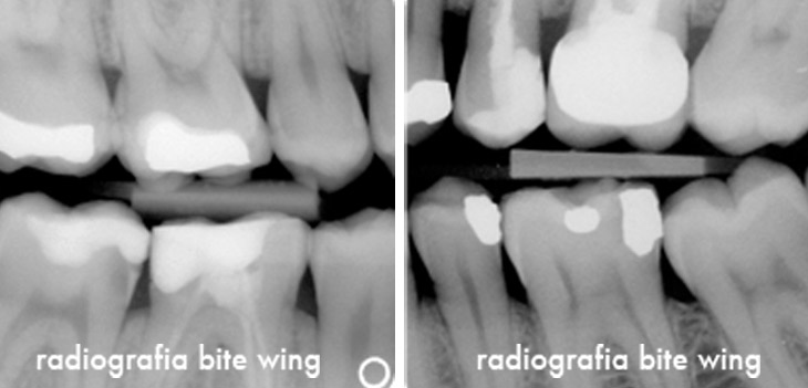 Caso Clinico Radiografia periapicale