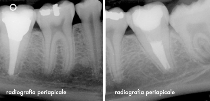 Caso Clinico Radiografia periapicale