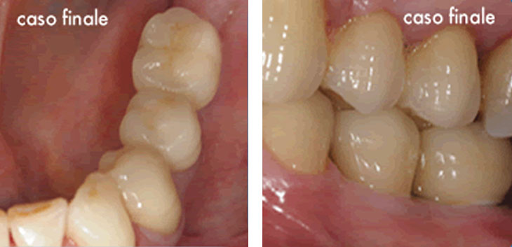 Riabilitazione di più elementi dentali