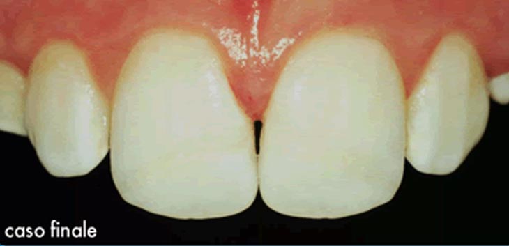 Ricostruzione di denti spezzati