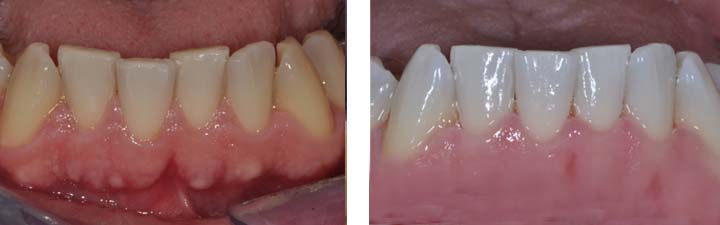 Sbiancamento Denti