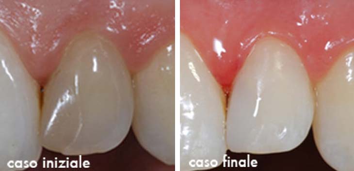 Caso Clinico Sbiancamento denti non vitali