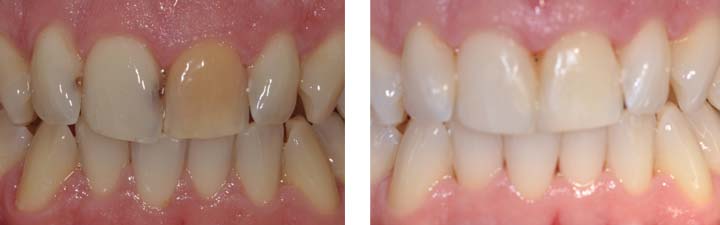 Caso Clinico Sbiancamento denti vitali
