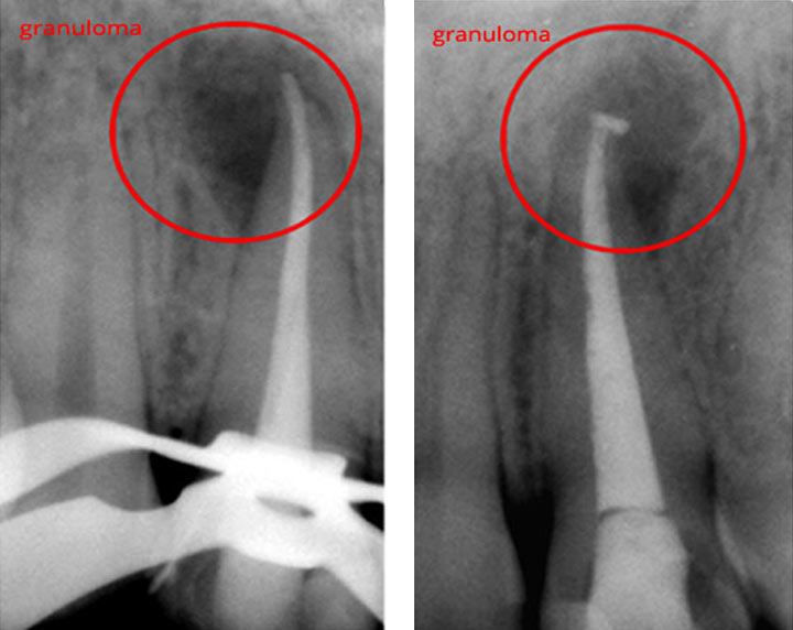 CASO CLINICO GRANULOMA