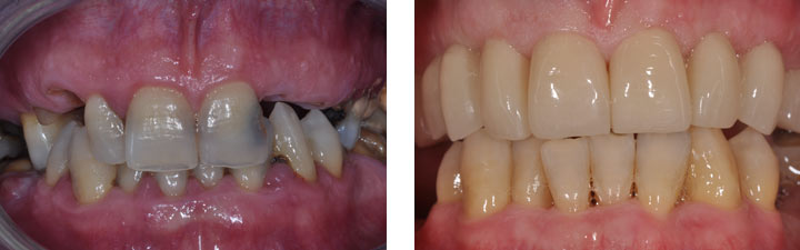 Terapia Causale parodontologica